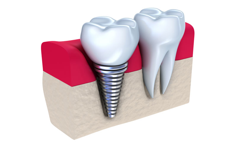 به پیچ ساخته شده از جنس تیتانیوم گفته می شود که در استخوان فک کاشته می شود. ایمپلنت در کرج